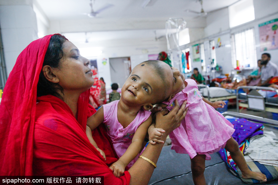 孟加拉國連頭嬰兒 至少到兩歲才能進行手術